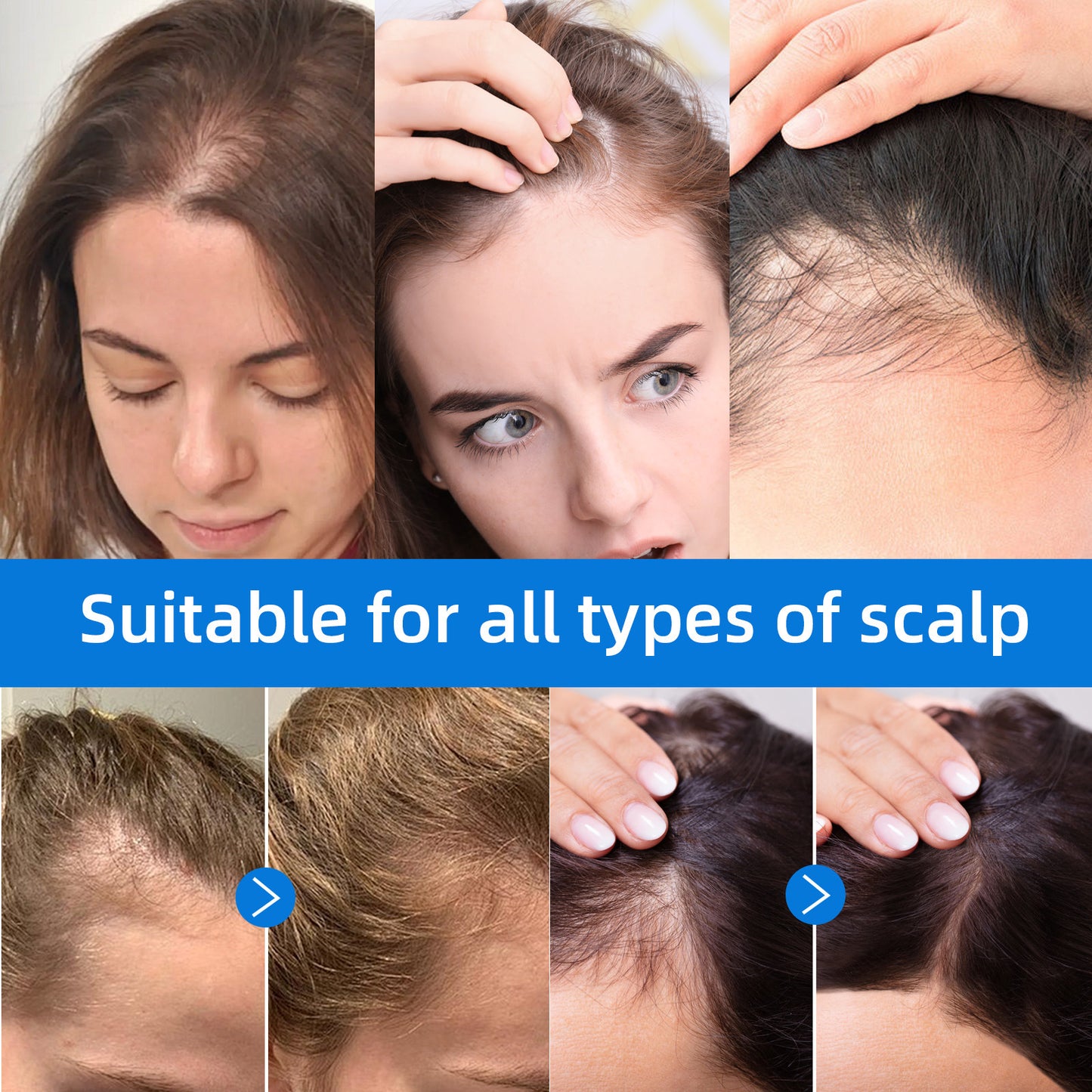 Hot-Selling Scalpy Anti-Hair Loss Serum | Thicker, Fuller Hair Naturally